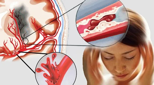 Những người bị nhồi máu não thường có điểm chung này: Liệu bạn có đang sống trong nguy cơ tắc mạch máu não?- Ảnh 3.