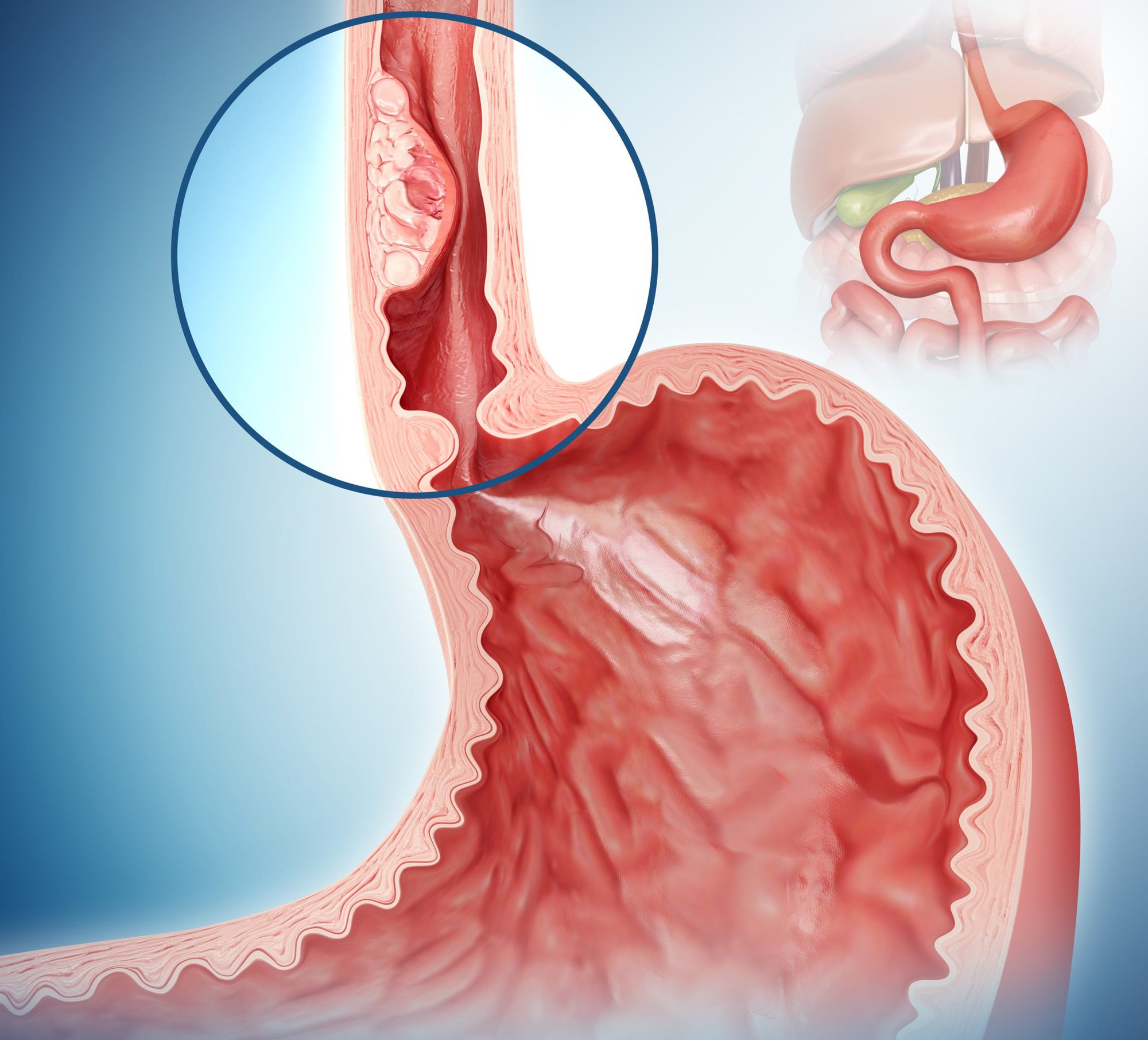 Thói quen ăn uống tưởng chừng vô hại âm thầm phá hủy tế bào, gia tăng nguy cơ ung thư thực quản- Ảnh 1. Thói quen ăn uống tưởng chừng vô hại âm thầm phá hủy tế bào, gia tăng nguy cơ ung thư thực quản- Ảnh 1.