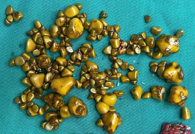 Người phụ nữ 'giấu cả trăm cục vàng' trong... túi mật- Ảnh 1.