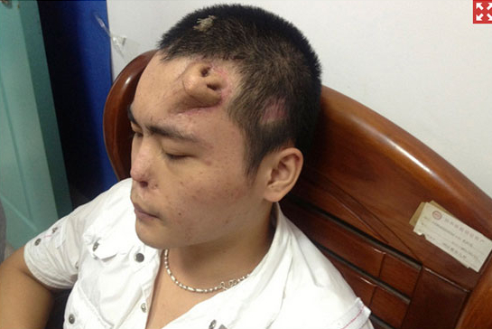 Không phải ảnh lỗi của AI, người đàn ông này đã thực sự mọc một chiếc mũi trên trán: Đó là "tác phẩm" của các bác sĩ Trung Quốc- Ảnh 1. Không phải ảnh lỗi của AI, người đàn ông này đã thực sự mọc một chiếc mũi trên trán: Đó là "tác phẩm" của các bác sĩ Trung Quốc- Ảnh 1.