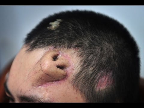 Không phải ảnh lỗi của AI, người đàn ông này đã thực sự mọc một chiếc mũi trên trán: Đó là "tác phẩm" của các bác sĩ Trung Quốc- Ảnh 4. Không phải ảnh lỗi của AI, người đàn ông này đã thực sự mọc một chiếc mũi trên trán: Đó là "tác phẩm" của các bác sĩ Trung Quốc- Ảnh 4.