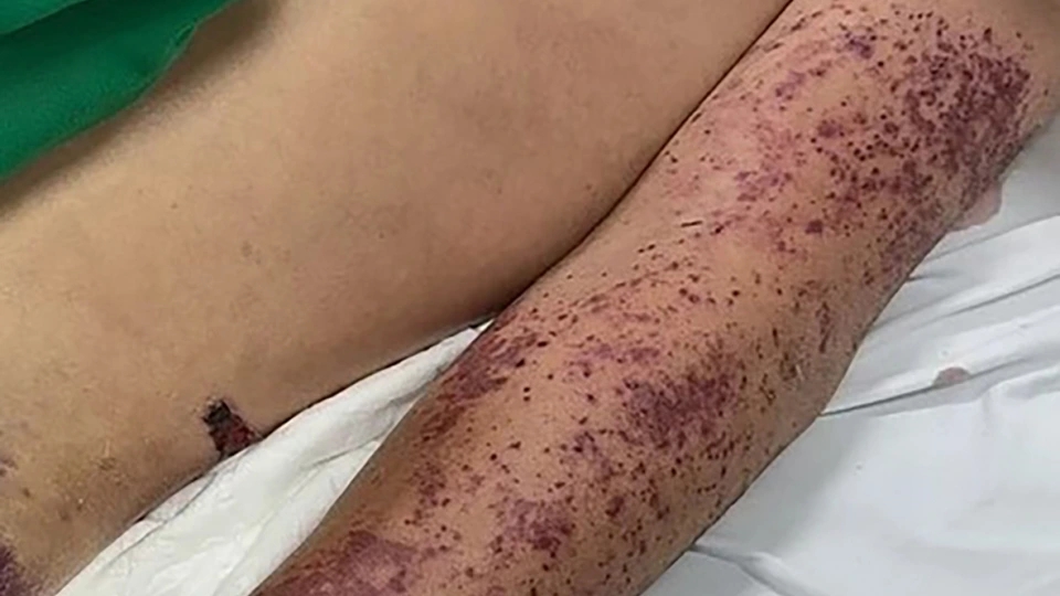 Hà Nội: Cụ bà bán lòng lợn ở Long Biên mắc liên cầu khuẩn- Ảnh 1. Hà Nội: Cụ bà bán lòng lợn ở Long Biên mắc liên cầu khuẩn- Ảnh 1.