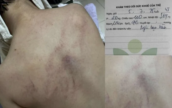 NÓNG - Vụ bé gái 4 tuổi bị cô giáo ném vào tường, đánh tím lưng: Bộ Y tế vào cuộc!- Ảnh 1. NÓNG - Vụ bé gái 4 tuổi bị cô giáo ném vào tường, đánh tím lưng: Bộ Y tế vào cuộc!- Ảnh 1.