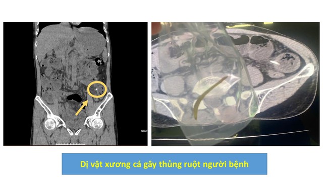Bất cẩn nuốt thuốc "cả vỏ", người phụ nữ nhập viện vì thủng dạ dày- Ảnh 2. Bất cẩn nuốt thuốc "cả vỏ", người phụ nữ nhập viện vì thủng dạ dày- Ảnh 2.