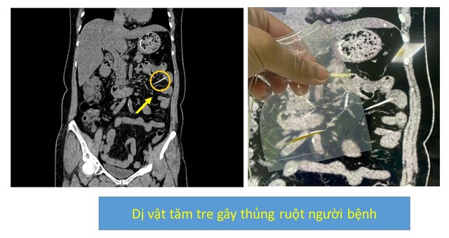 Bất cẩn nuốt thuốc "cả vỏ", người phụ nữ nhập viện vì thủng dạ dày- Ảnh 3. Bất cẩn nuốt thuốc "cả vỏ", người phụ nữ nhập viện vì thủng dạ dày- Ảnh 3.