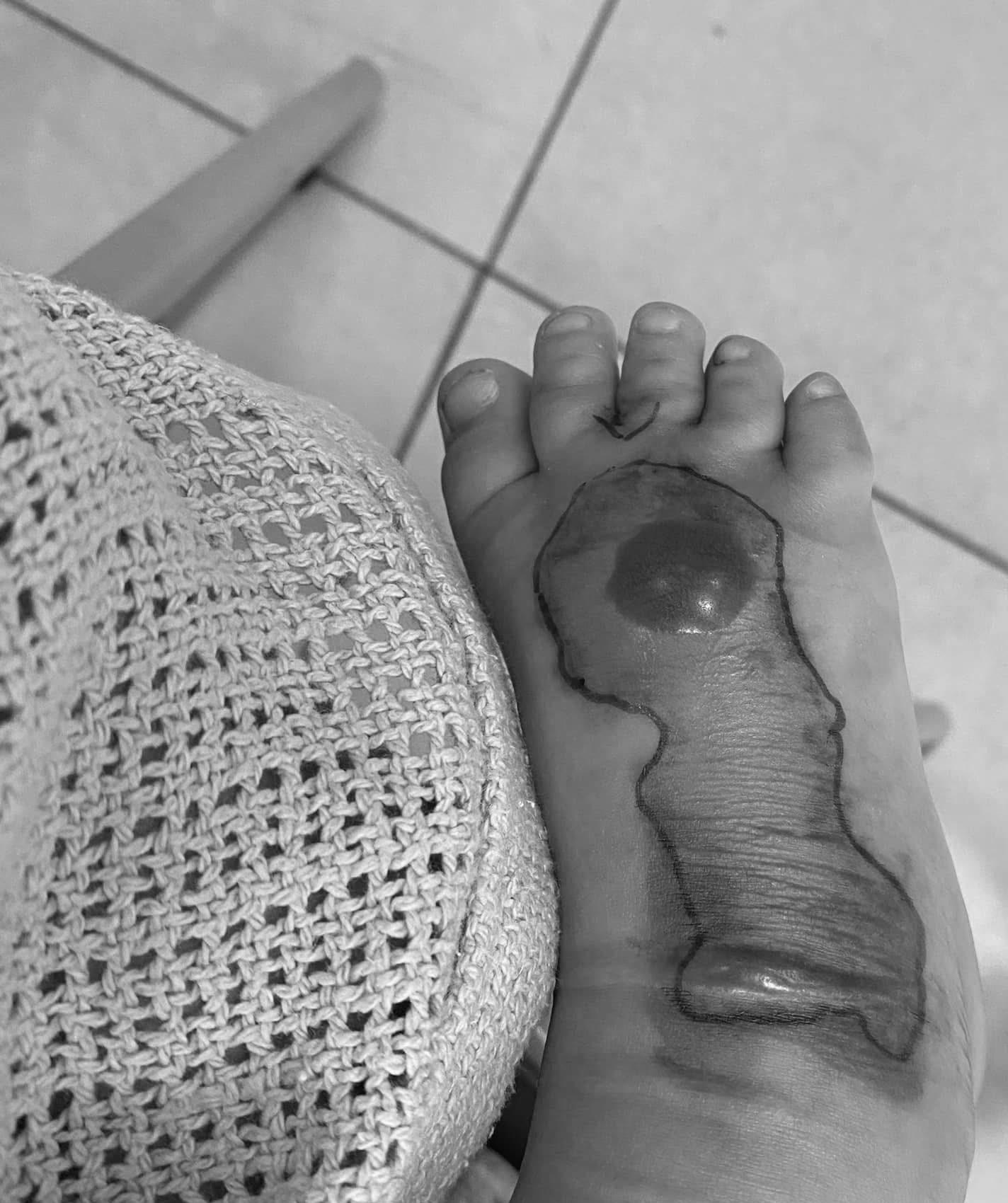 Chỉ một vết mèo cào tưởng vô hại, em bé phải cắt bỏ một phần chân khiến phụ huynh sợ hãi- Ảnh 3.
