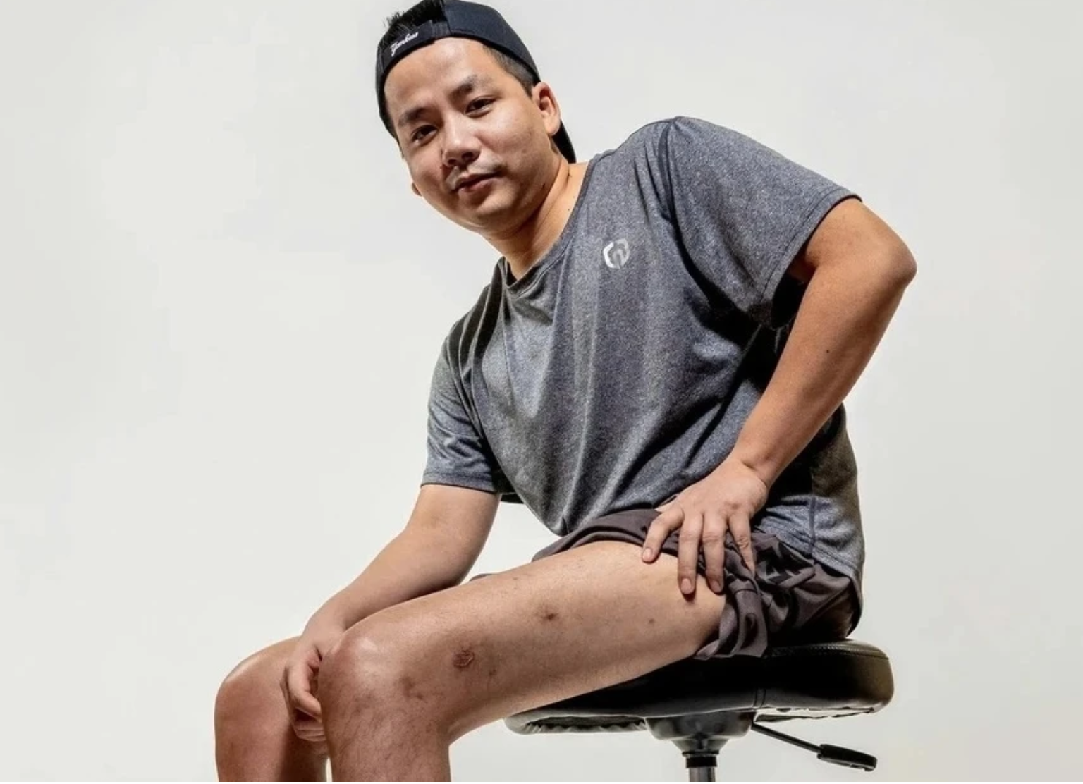 YouTuber "giàu nhất Việt Nam" chi gần 3 tỷ đồng để kéo chân dài thêm 7 cm: Bác sĩ nói gì?- Ảnh 1. YouTuber "giàu nhất Việt Nam" chi gần 3 tỷ đồng để kéo chân dài thêm 7 cm: Bác sĩ nói gì?- Ảnh 1.