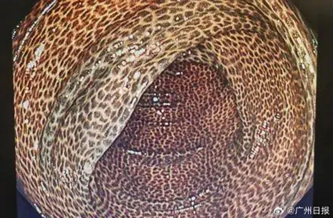 Ruột của người đàn ông lốm đốm như "da rắn" vì uống trà giảm cân suốt 2 năm- Ảnh 1.