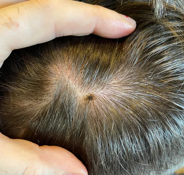 KIỂM TRA NGAY: Nốt ruồi mọc ở 6 vị trí này trên cơ thể rất dễ "biến hình" thành ung thư!- Ảnh 3.