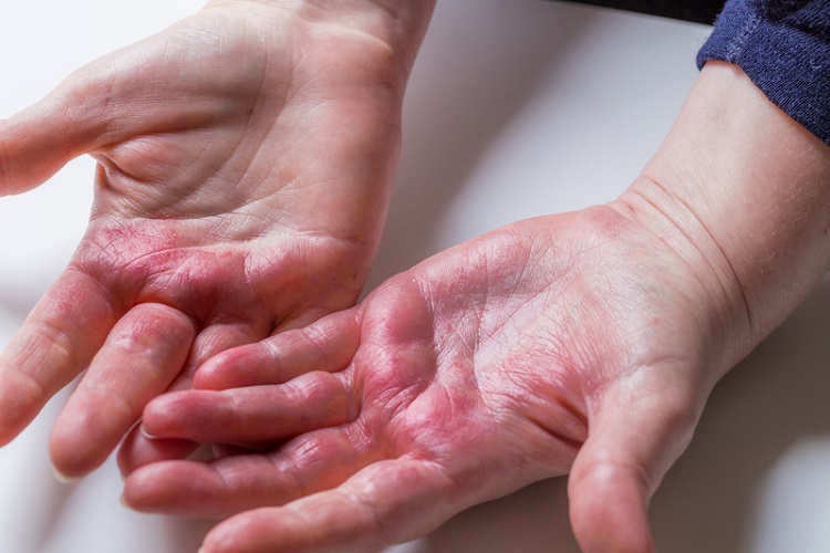 “3 ngứa, 2 đau” thực chất là triệu chứng ung thư gan giai đoạn đầu dễ bị bỏ qua nhất- Ảnh 1. “3 ngứa, 2 đau” thực chất là triệu chứng ung thư gan giai đoạn đầu dễ bị bỏ qua nhất- Ảnh 1.