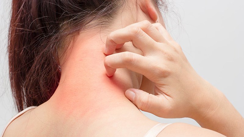 Dị ứng thời tiết: Vì sao bạn bị ngứa, nổi mẩn mỗi khi giao mùa?- Ảnh 2. Dị ứng thời tiết: Vì sao bạn bị ngứa, nổi mẩn mỗi khi giao mùa?- Ảnh 2.