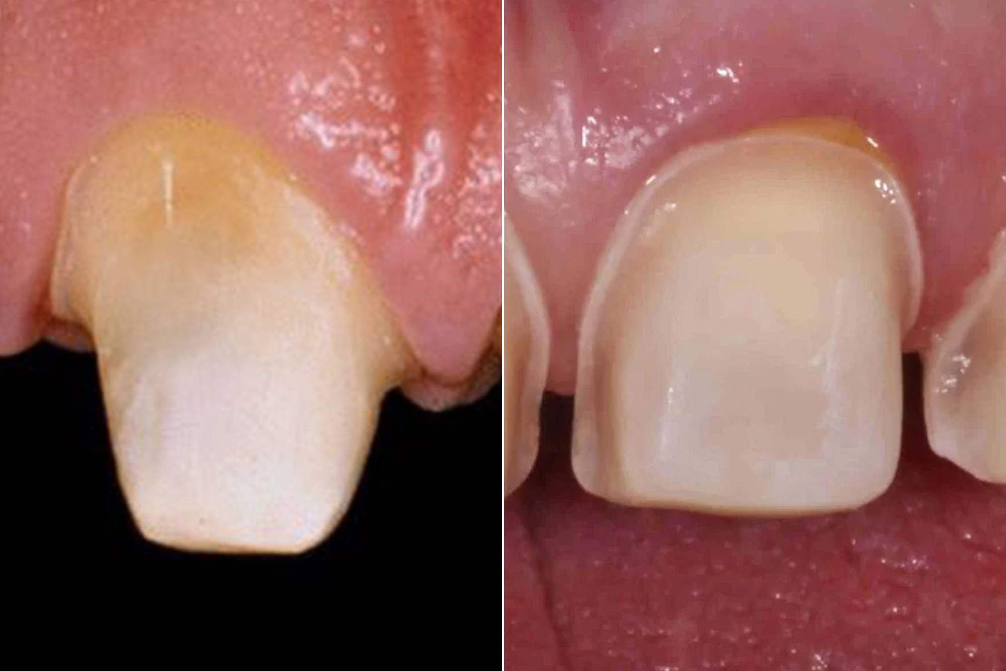 Dán sứ Veneer: Khi thẩm mỹ răng gắn liền bảo tồn- Ảnh 1. Dán sứ Veneer: Khi thẩm mỹ răng gắn liền bảo tồn- Ảnh 1.