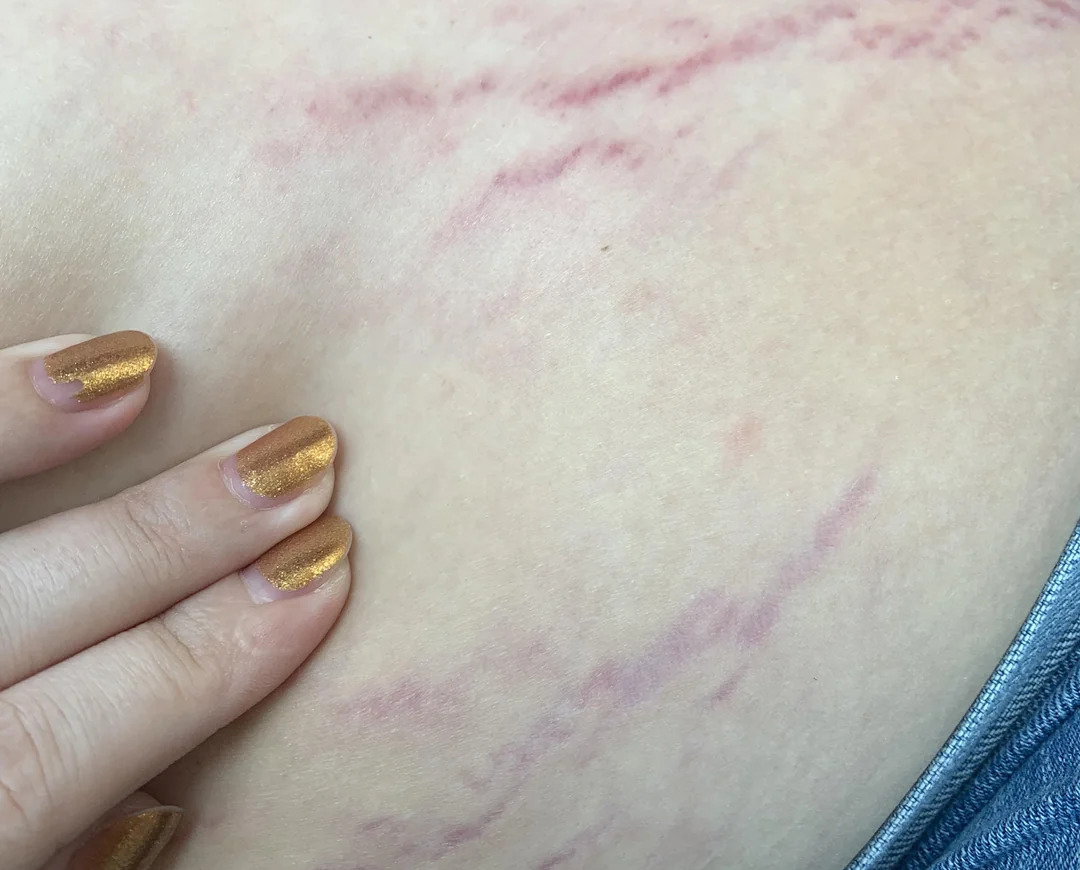 5 thay đổi về ngoại hình là BÁO ĐỘNG bởi ung thư tuyến yên, rất dễ bị nhầm với tăng cân- Ảnh 2. 5 thay đổi về ngoại hình là BÁO ĐỘNG bởi ung thư tuyến yên, rất dễ bị nhầm với tăng cân- Ảnh 2.