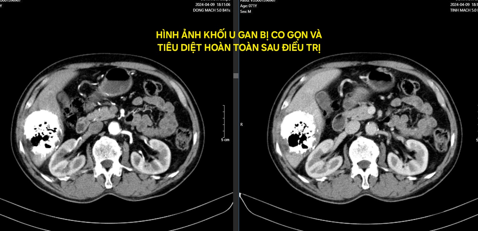 Mắc ung thư giai đoạn cuối, cụ ông kiên trì làm 1 việc khiến khối u biến mất hoàn toàn, bác sĩ nể phục- Ảnh 2.