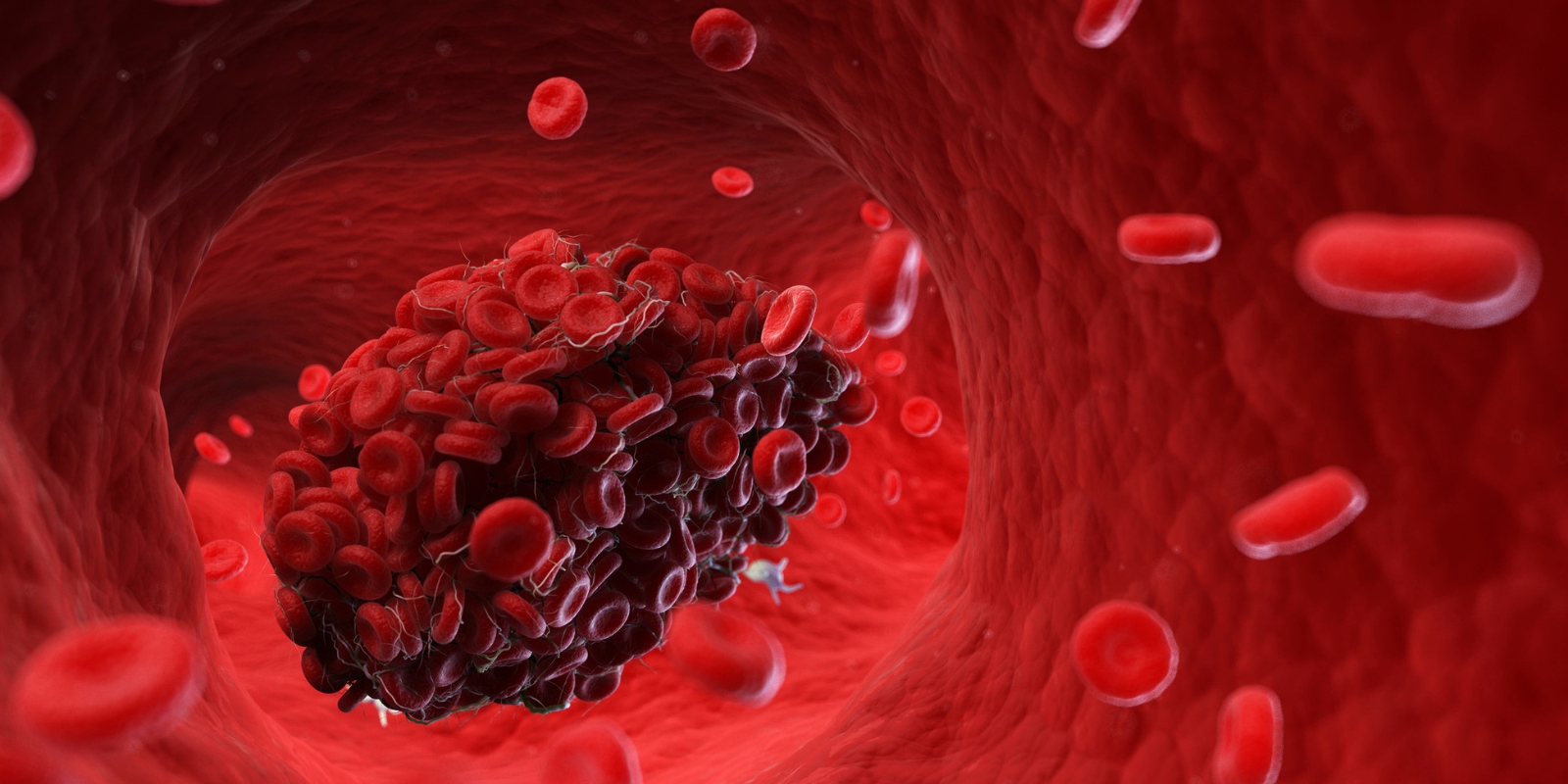 Cục máu đông rất "sợ" 1 thói quen đơn giản buổi sáng: Thường xuyên làm giúp tránh xa đột quỵ, đau tim- Ảnh 1.