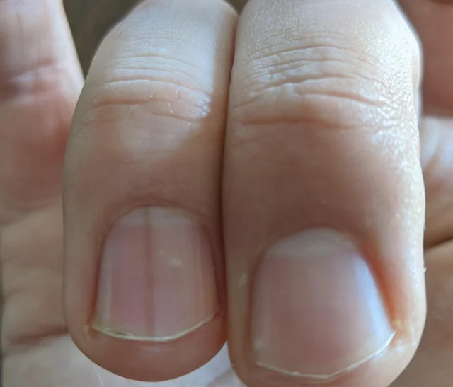 7 bất thường trên móng tay lộ ngay người “giấu” khối u trong cơ thể, kiểm tra xem bạn có không!- Ảnh 1.