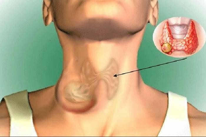 Mẹ đưa con gái đi khám vì khàn tiếng, cả hai phát hiện cùng mắc ung thư- Ảnh 1.