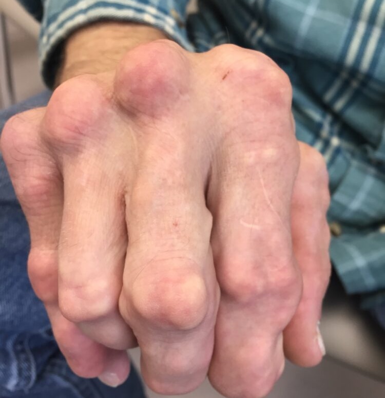 gout hand tophi 2 gout hand tophi 2