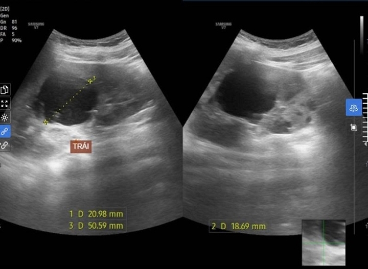 Nam sinh 15 tuổi khỏe mạnh đi khám phát hiện bị bệnh lý ba đời cùng mắc- Ảnh 1.