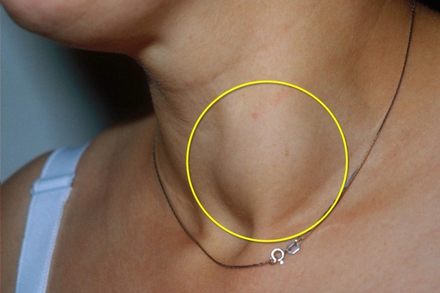 8 người một nhà cùng mắc ung thư tuyến giáp, bác sĩ nhắc nhở: Thấy 5 thay đổi này, e rằng "tế bào ung thư” đã lớn- Ảnh 2.