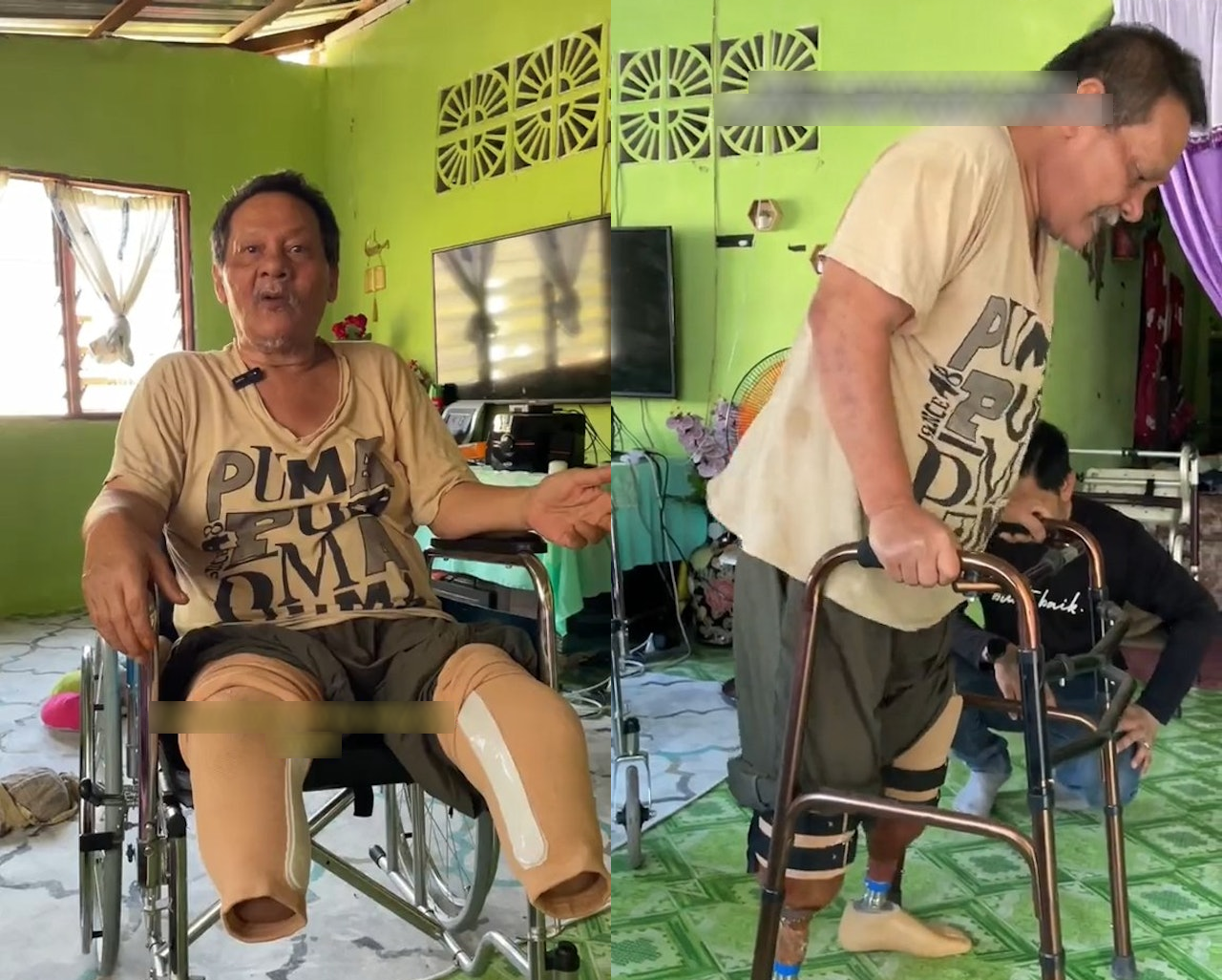 Đừng uống nước ngọt theo cách này: Người đàn ông phải cắt bỏ cả hai chân, nhiều tiền cũng trở nên vô nghĩa- Ảnh 1.