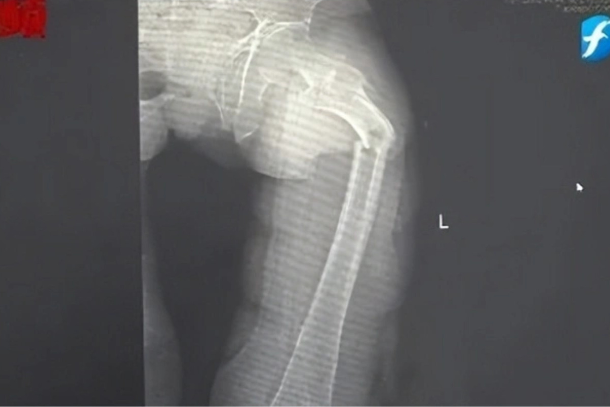 Ngoài 30 tuổi xương đã "xốp như tổ ong", ho cũng gãy xương đùi vì mê loại nước "ngòn ngọt", uống tê đầu lưỡi - Ảnh 2.