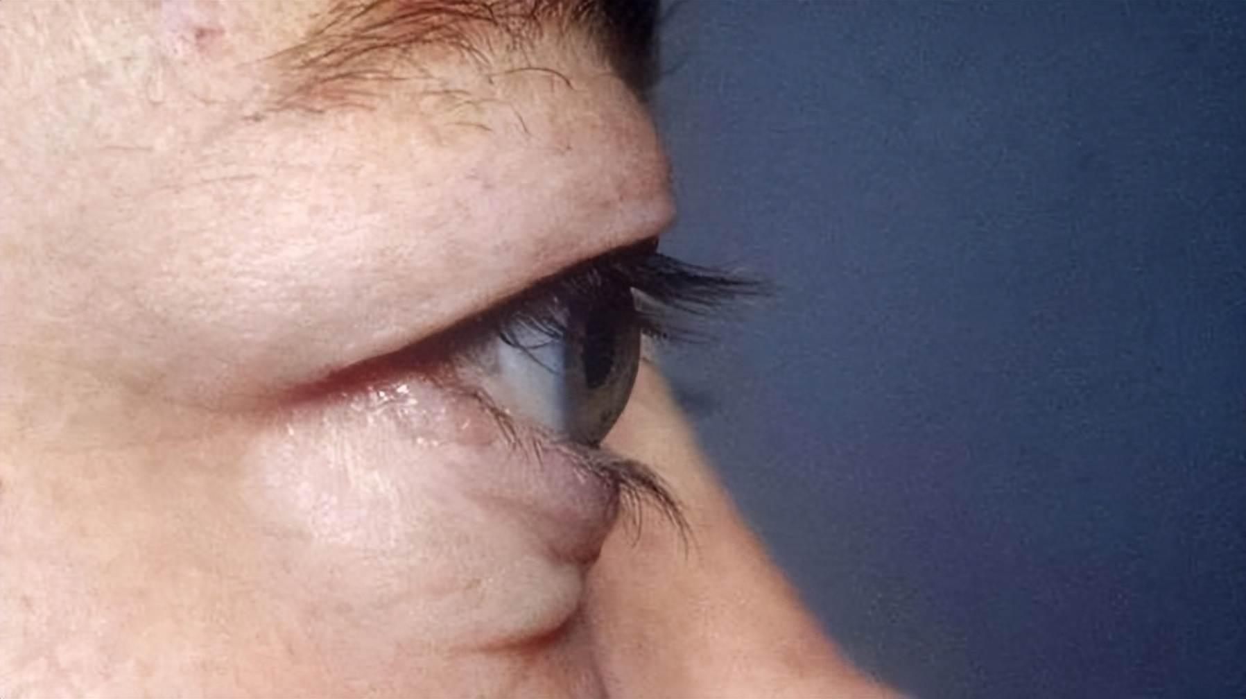 8 dấu hiệu bất thường ở mắt cảnh báo bệnh nghiêm trọng: Đặc biệt, dấu hiệu thứ 5 rất nhiều người chủ quan bỏ qua- Ảnh 4.