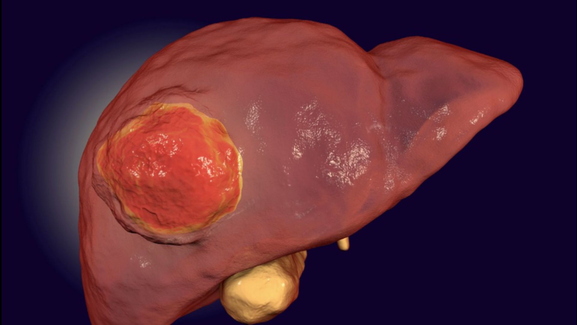 Bác sĩ chỉ ra 5 thói quen ăn uống nuôi "ung thư gan" của nhiều người trẻ - Ảnh 1.