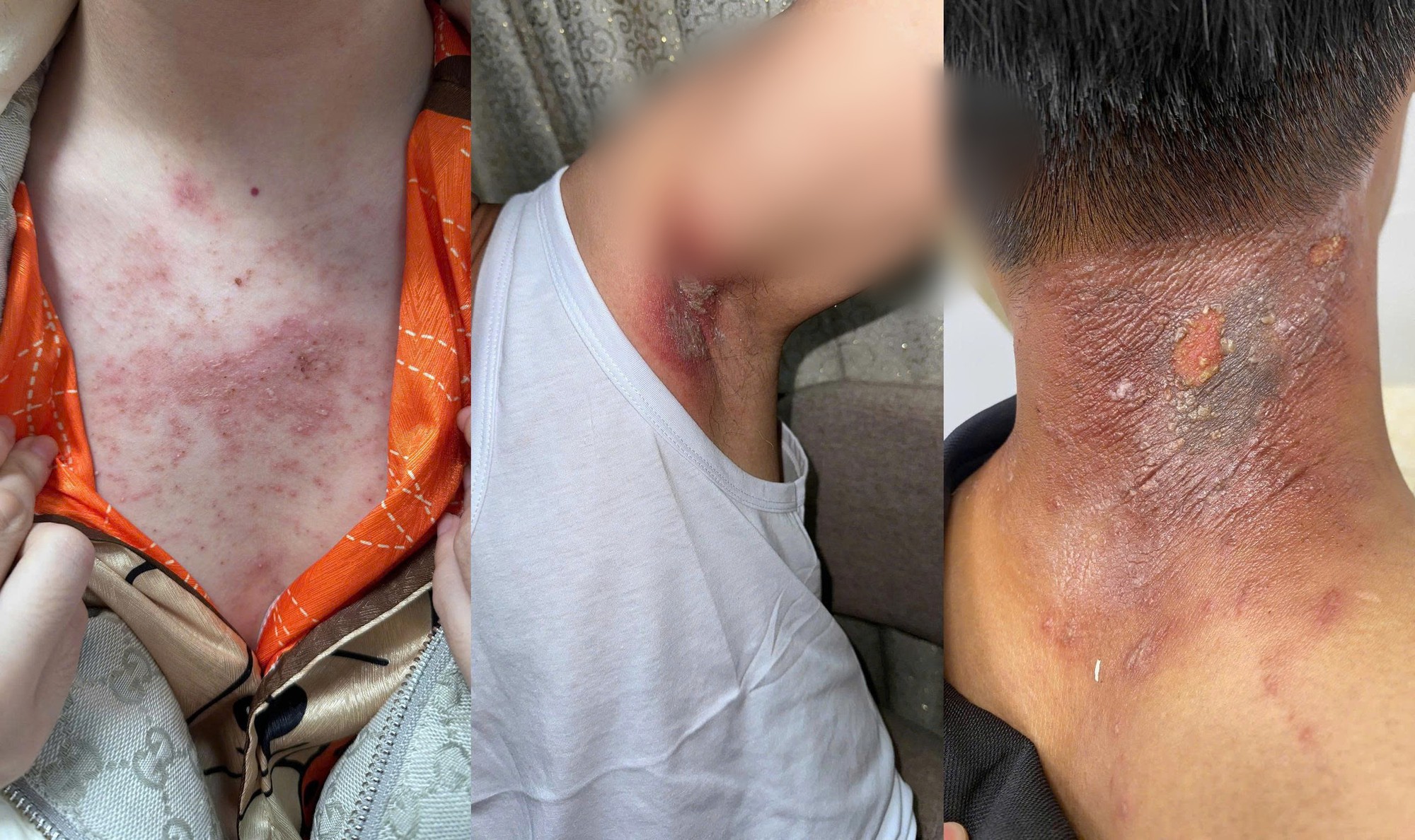 Kiến ba khoang "vào mùa", cẩn trọng dễ nhầm với zona thần kinh - Ảnh 1.