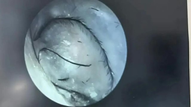 Người phụ nữ ngứa tai đi khám, bác sĩ phát hiện thứ bất ngờ bên trong- Ảnh 1.