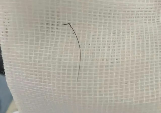 Người phụ nữ ngứa tai đi khám, bác sĩ phát hiện thứ bất ngờ bên trong- Ảnh 2.