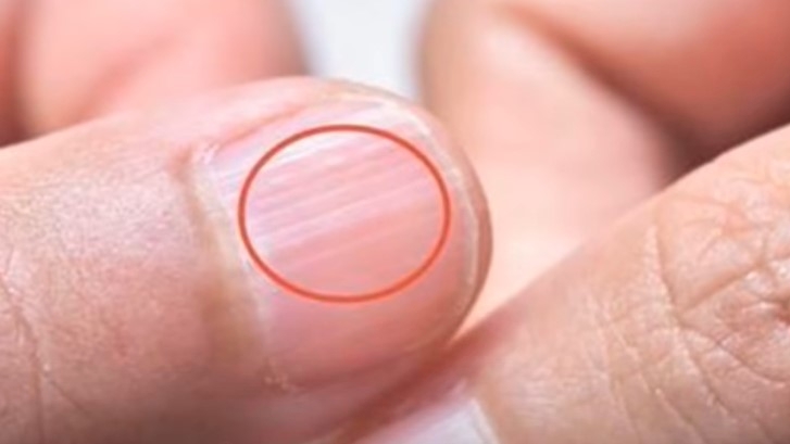 Bàn tay là tín hiệu cảnh báo sức khỏe: 1 thay đổi có thể cho thấy bệnh tiểu đường hoặc xơ gan- Ảnh 3.