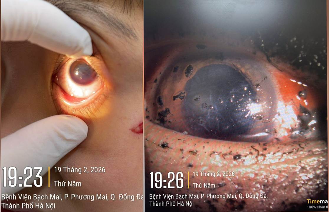 Bệnh viện Bạch Mai cảnh báo 1 tình trạng bệnh ở mắt tăng vọt ngay trong 3 ngày đầu năm 2026- Ảnh 1.