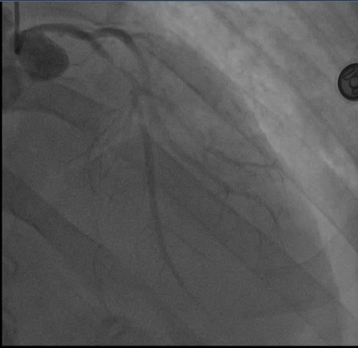 Mạch máu chính nuôi tim người đàn ông tắc tới 99%: Bác sĩ chỉ đích danh nguyên nhân- Ảnh 1.