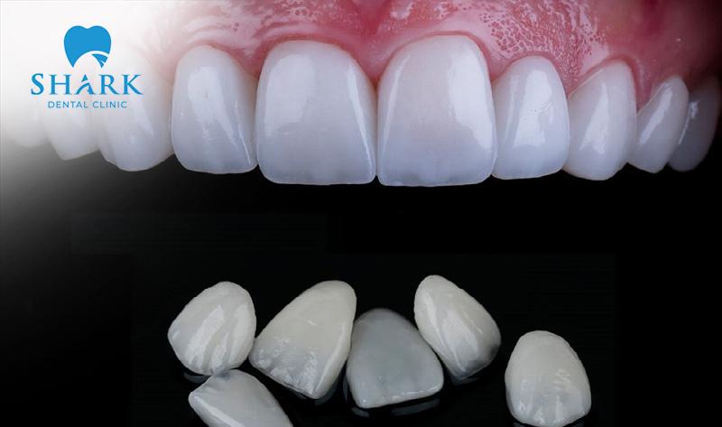 Dán răng sứ Veneer - Giải pháp phục hình răng an toàn, hiệu quả - Ảnh 1.