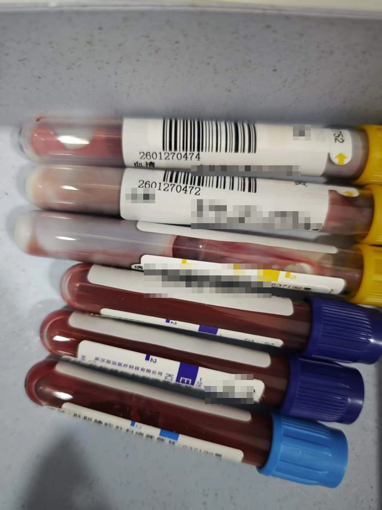 Nam sinh năm nhất "máu trắng như sữa", mỡ máu cao gấp 47 lần bình thường vì thói quen ăn uống nhiều người mắc - Ảnh 1.