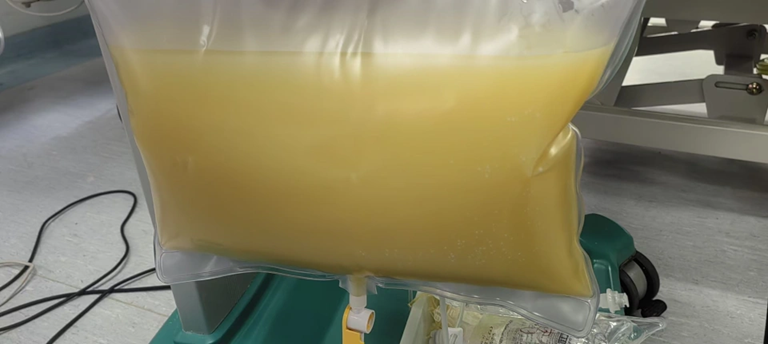 Nam sinh năm nhất "máu trắng như sữa", mỡ máu cao gấp 47 lần bình thường vì thói quen ăn uống nhiều người mắc - Ảnh 2.