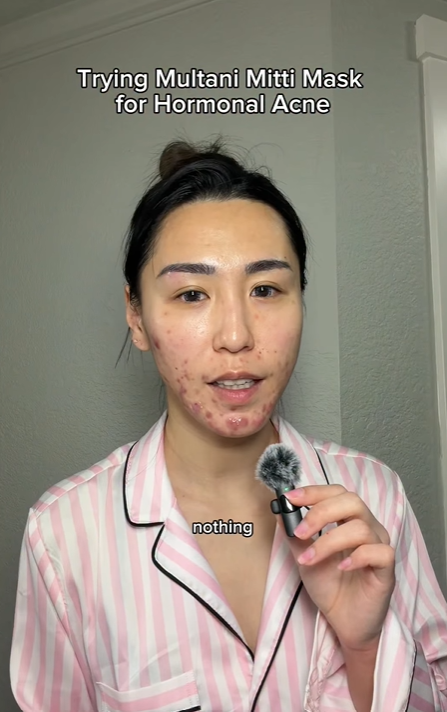 Bị đuổi việc, cô gái 27 tuổi để mặt mộc với mảng mụn lớn lên mạng tâm sự và cái kết bất ngờ- Ảnh 3.