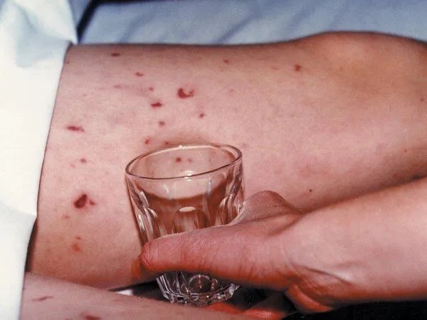 Gia tăng căn bệnh dễ lây, ‘tấn công’ vào não: Bác sĩ chỉ cách nhận biết ở giai đoạn mới nhiễm- Ảnh 1.