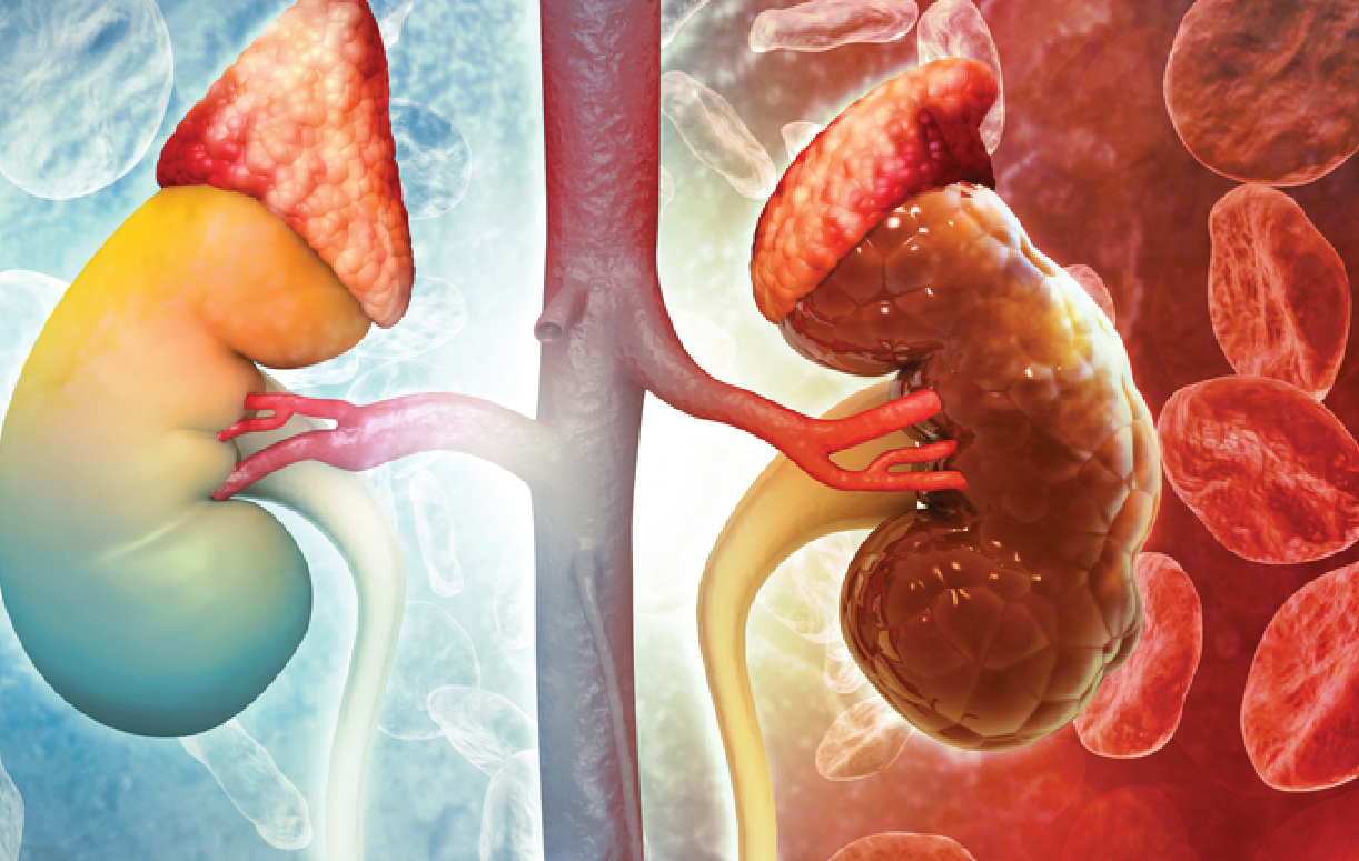 Suy thận có thể tấn công bất ngờ không báo trước: Đây là 4 đối tượng cần đặc biệt cảnh giác- Ảnh 1.