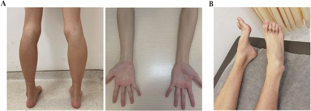 Gia tộc Samsung và căn bệnh di truyền đáng sợ mang tên teo cơ MÁC: Có tất cả nhưng cũng không thể chữa khỏi- Ảnh 7.