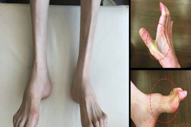 Gia tộc Samsung và căn bệnh di truyền đáng sợ mang tên teo cơ MÁC: Có tất cả nhưng cũng không thể chữa khỏi- Ảnh 4.