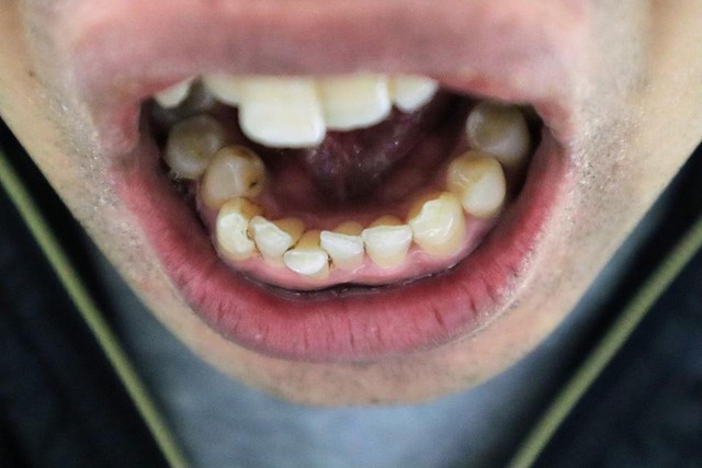 Vẫn bị hôi miệng dù đánh răng bao nhiêu lần đi nữa, bác sĩ tiết lộ "thủ phạm thực sự": Nhiều người ho ra "hạt gạo" có mùi hôi- Ảnh 1.