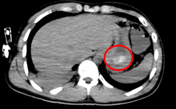Chàng trai 24 tuổi phải rửa ruột vì sáng tỉnh dậy bỗng có 150 viên thuốc trong bụng - Ảnh 2.
