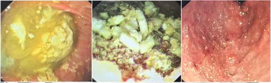 Chàng trai 24 tuổi phải rửa ruột vì sáng tỉnh dậy bỗng có 150 viên thuốc trong bụng - Ảnh 3.