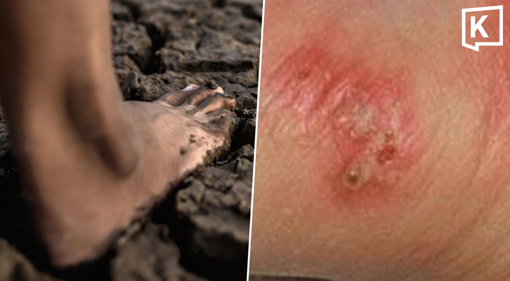 Thái Lan cảnh báo khẩn về dịch "sốt đất": 732 ca nhiễm, 23 trường hợp tử vong- Ảnh 1.