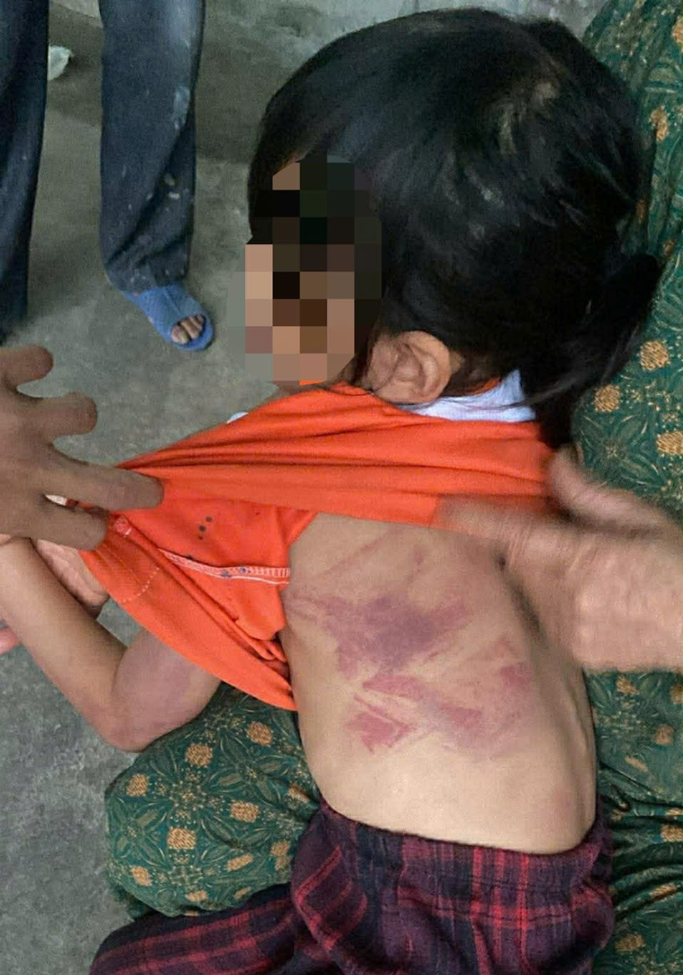 Bé gái lớp 2 bị bạn nam cùng lớp dùng thước dẻo đánh thâm tím người vì không cho kẹo - Ảnh 1.