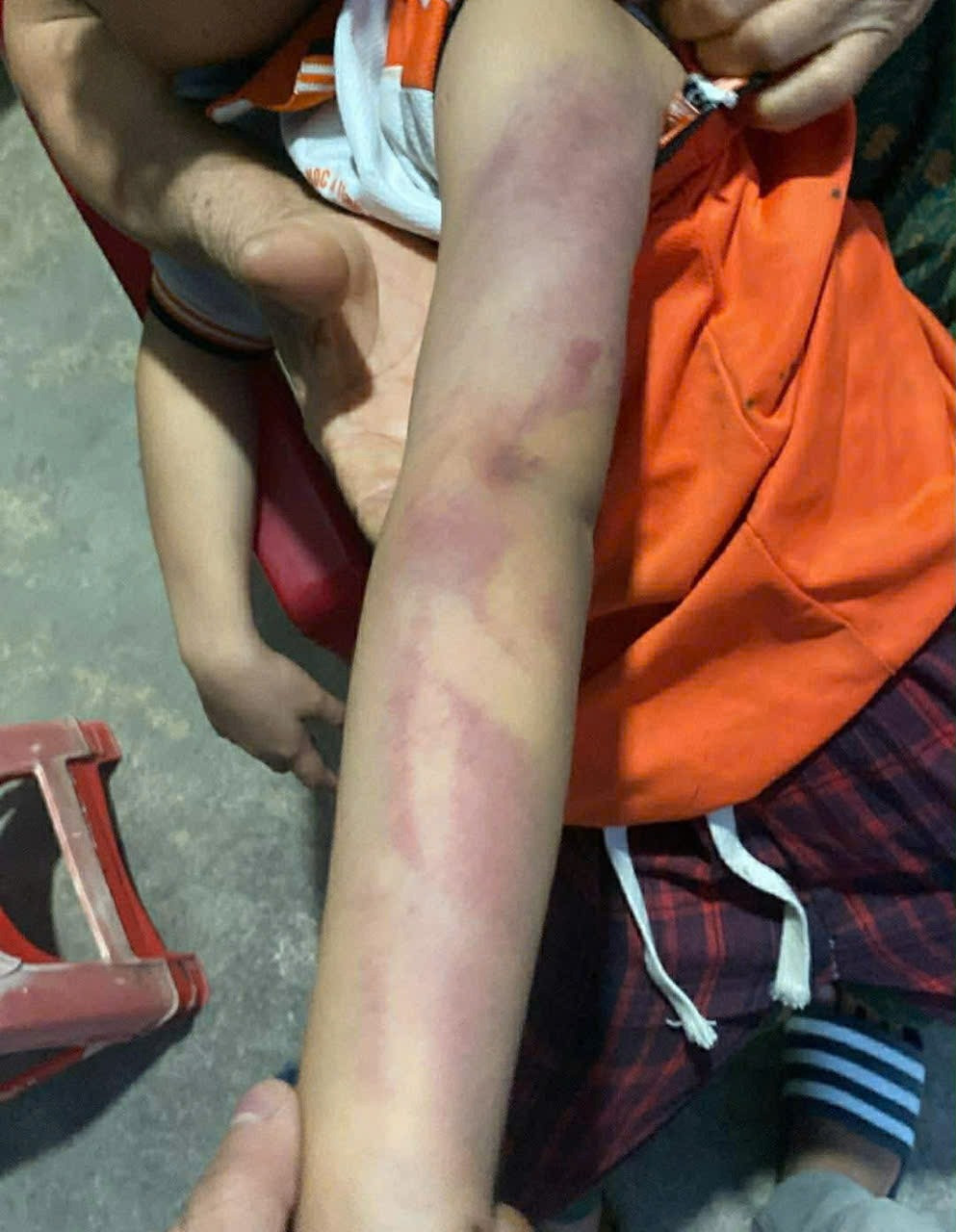 Bé gái lớp 2 bị bạn nam cùng lớp dùng thước dẻo đánh thâm tím người vì không cho kẹo - Ảnh 2.