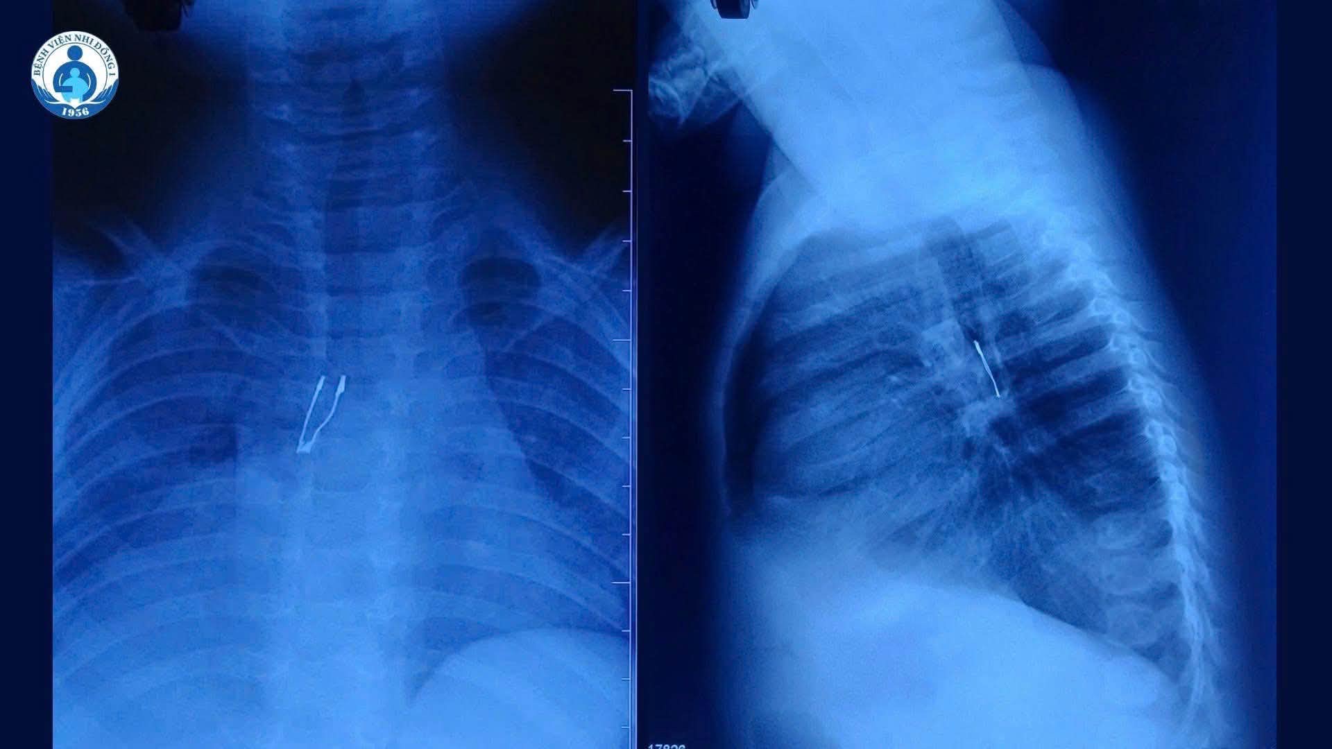 Bác sĩ thót tim gắp đèn led nằm trong phế quản bé 9 tháng tuổi - Ảnh 1.