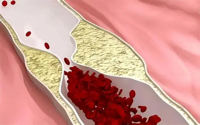 Thứ "không ngọt, không béo, không quá mặn" nhưng âm thầm bào mòn mạch máu và xương: Nhiều người ăn mỗi ngày mà không biết- Ảnh 4.